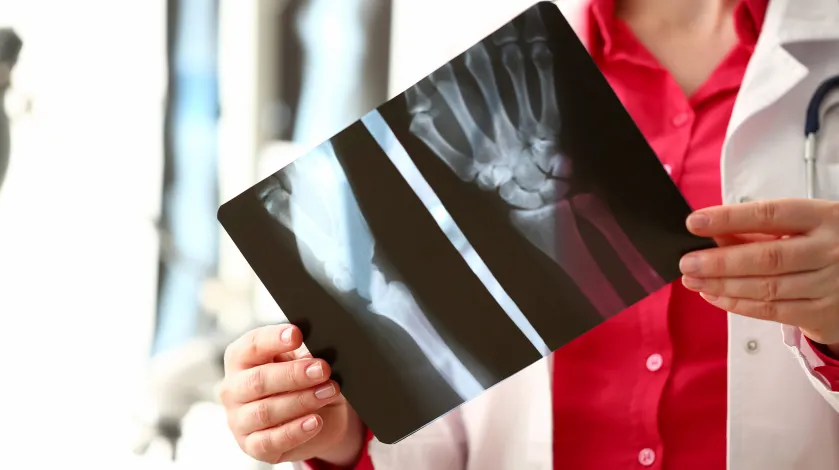 A close-up of a hand x-ray being held up and examined by a doctor