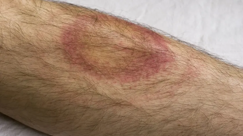 An erythema migrans (EM) rash from Lyme disease on a man's arm